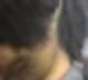 두피 건선 — 약 없이 관리 가능한가? 시술 사례 8